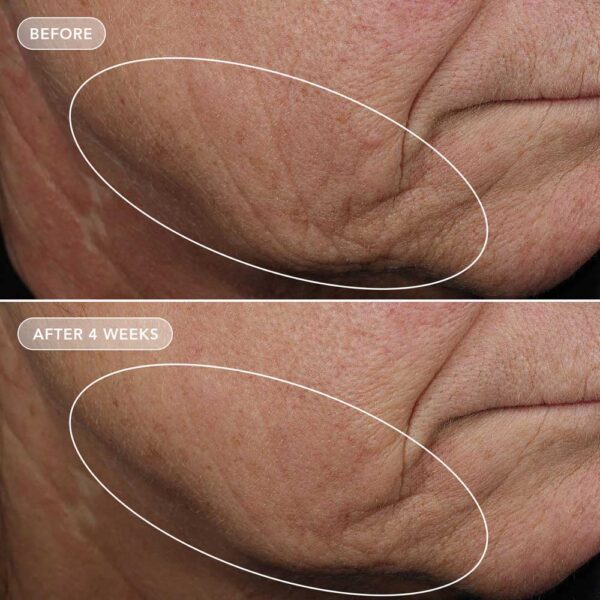 Volulift_BeforeAndAfter_subject_1 VOL.U.LIFT™ 4D SKIN REBOUND COMPLEX