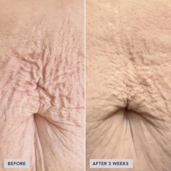 imageskincare-volulift-body-before-after2.jpg VOL.U.LIFT™ BODY kiinteyttävä vartalovoide